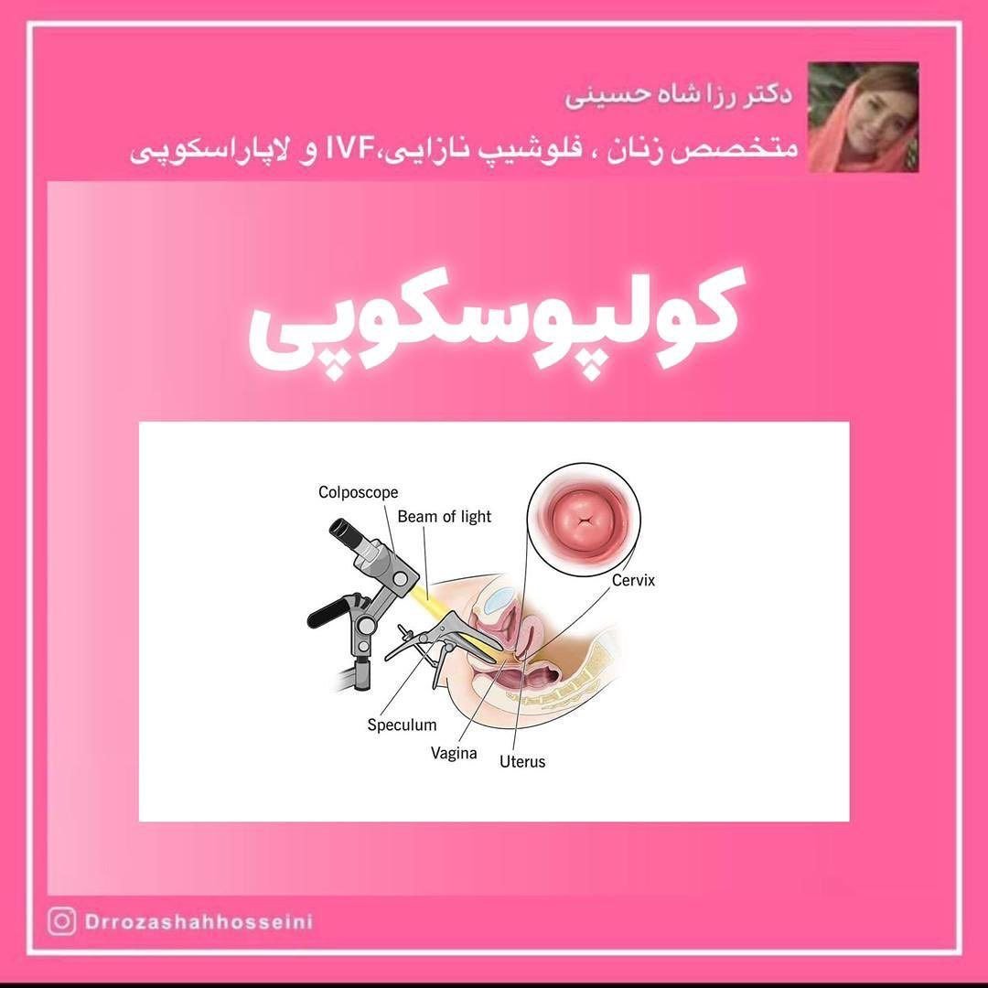 کولپوسکوپی