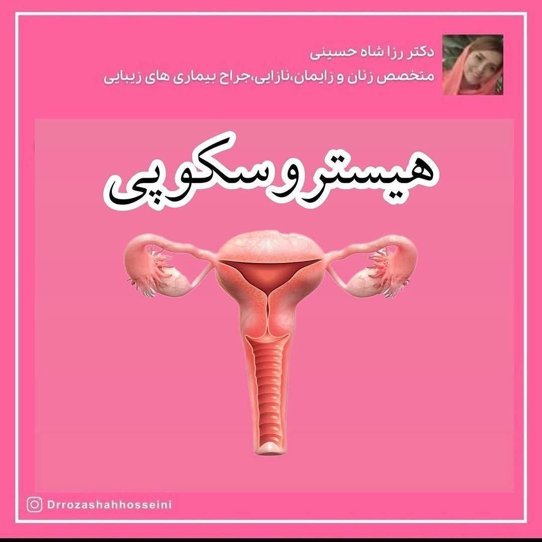 هیستروسکوپی